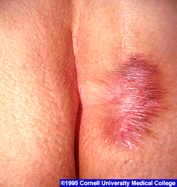 syphilis on thigh